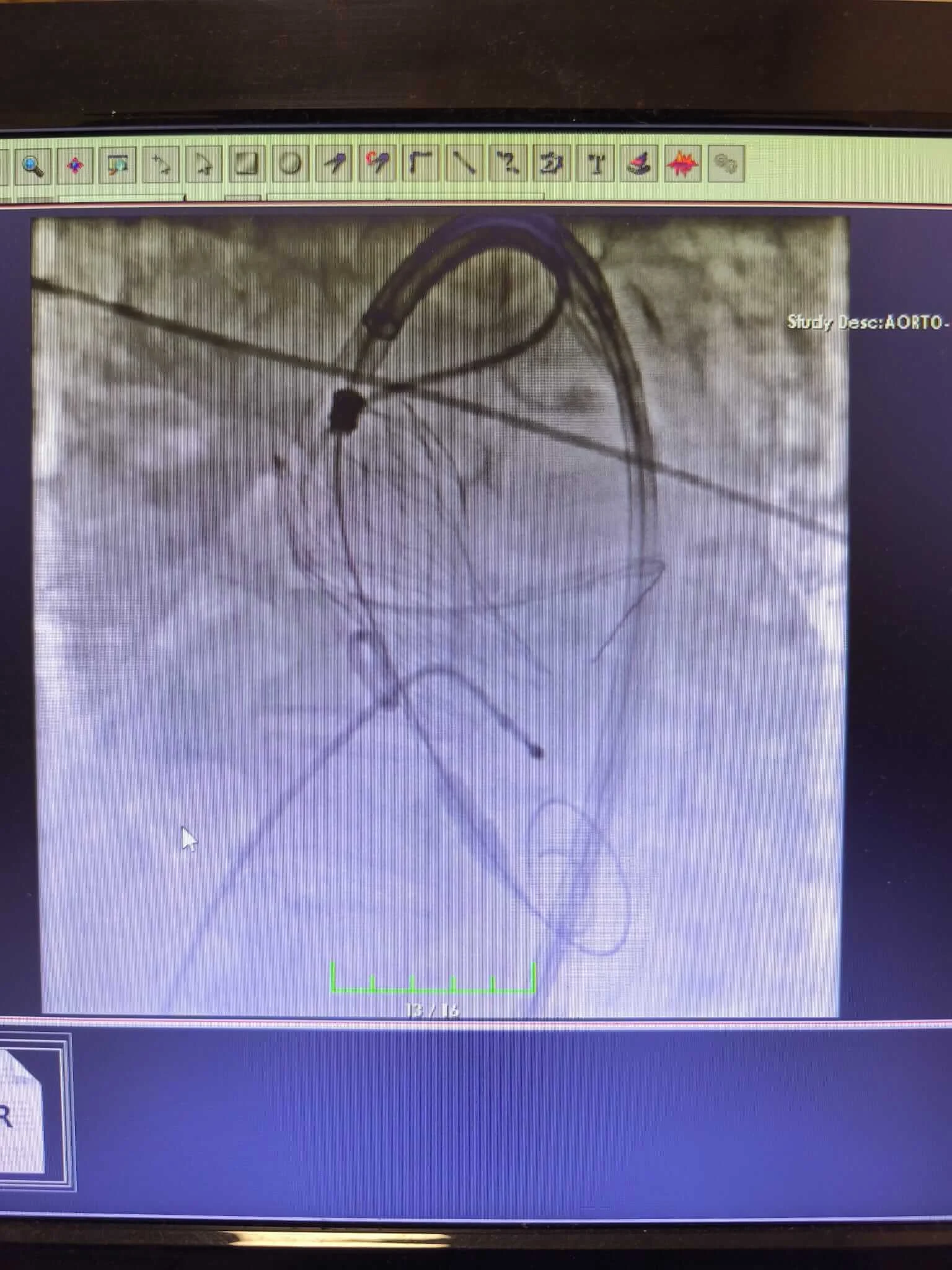 Kırıkkale Tıp Fakültesi’nde Bir İlk: Ameliyatsız Kalp Kapak Değişimi Kardiyoloji Kliniği Tarafından Başarıyla Gerçekleşti