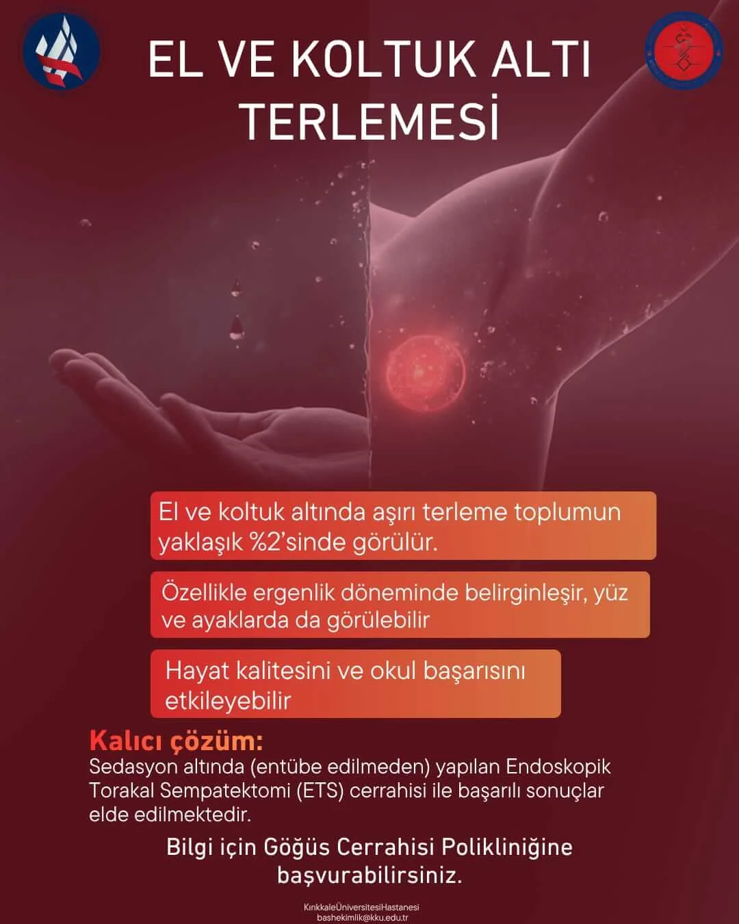 Kırıkkale Üniversitesi Tıp Fakültesi Hastanesi’nde Aşırı Terleme Sorununa Kalıcı Çözüm: ETS Yöntemi Umut Oluyor